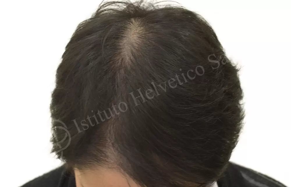 Rimedio alopecia femminile trapianto dei capelli
