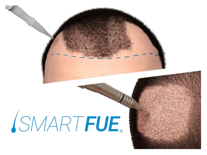 Trapianto dei Capelli - Tecnica Smart Fue