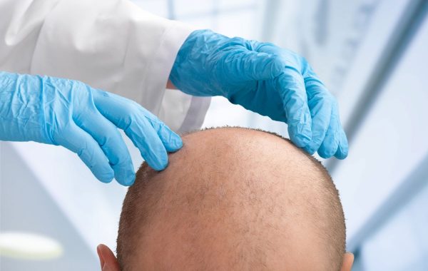 La Guida Completa Al Trapianto Di Capelli