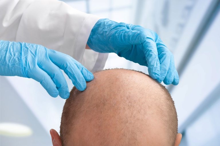 trapianto capelli guida