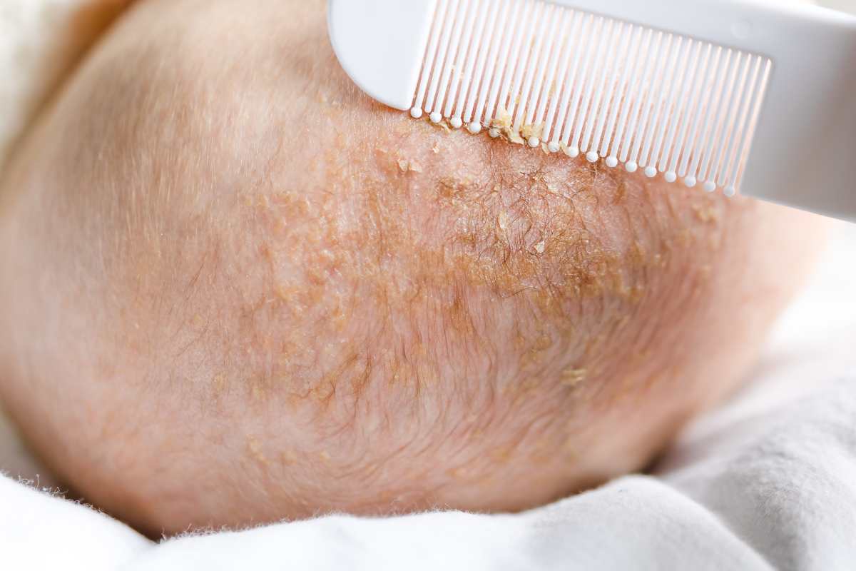Alopecia infantile, quali sono le cause e come intervenire