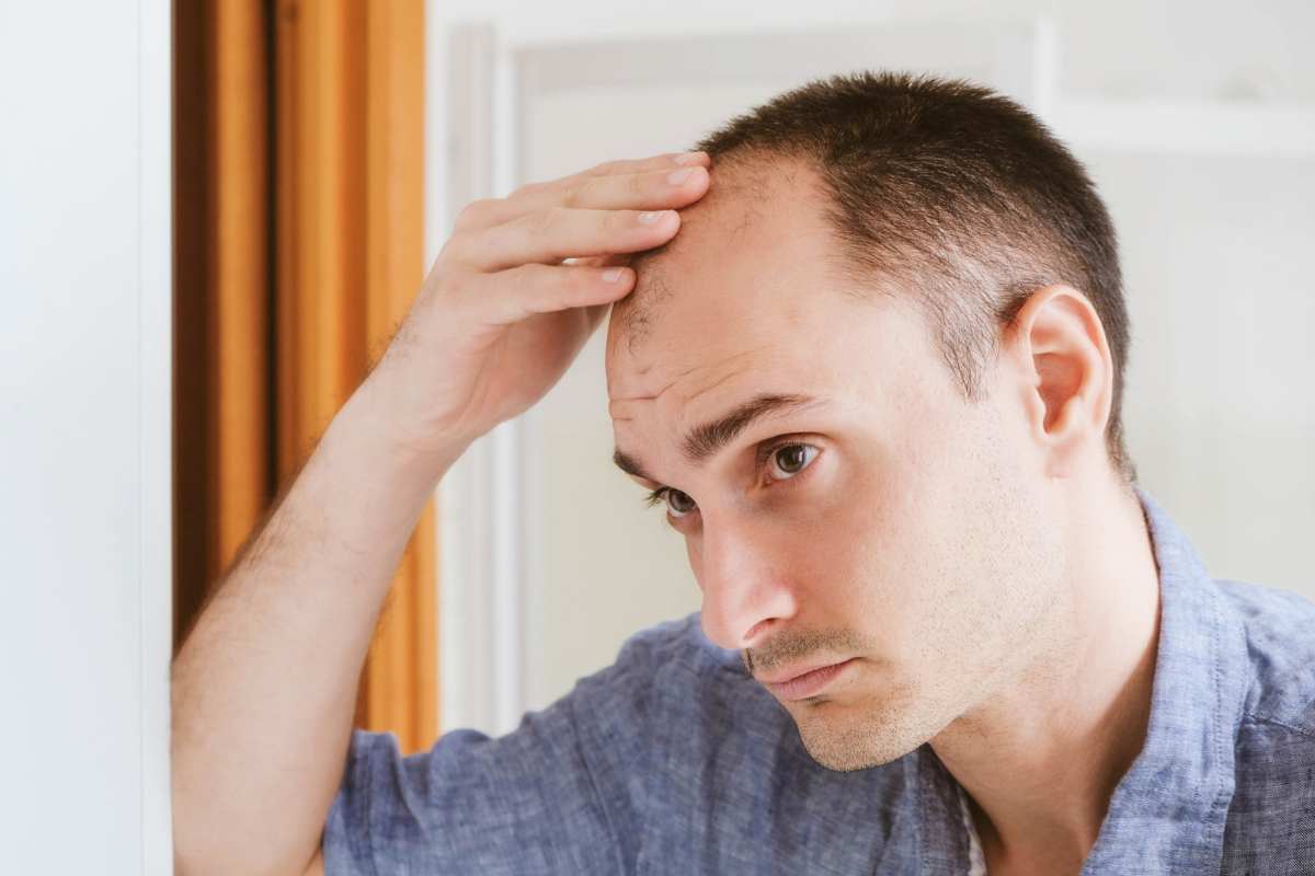 Tipo di alopecia frontoparietale