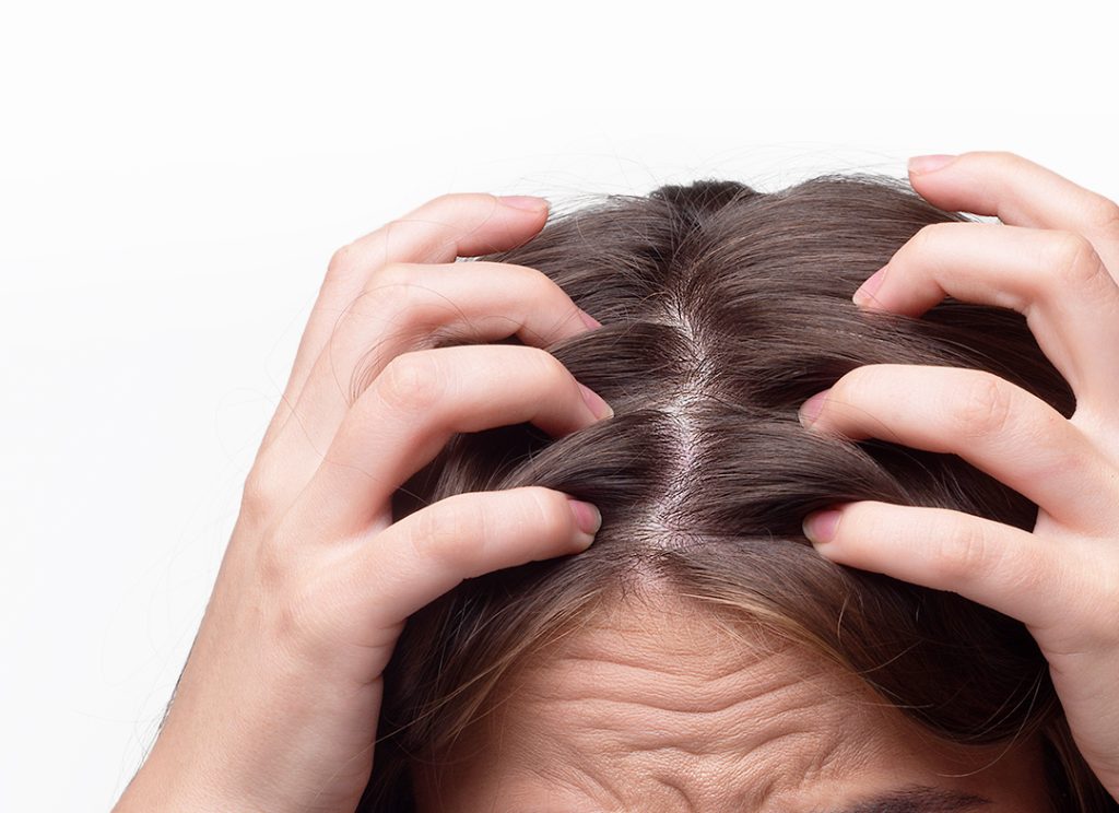 Cause della caduta dei capelli nella donna