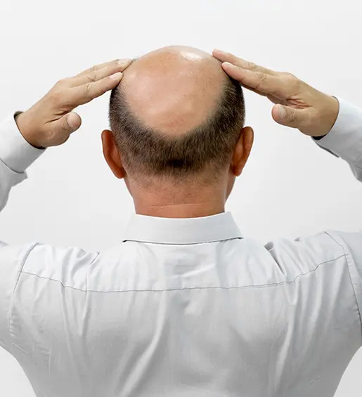 Alopecia androgenetica