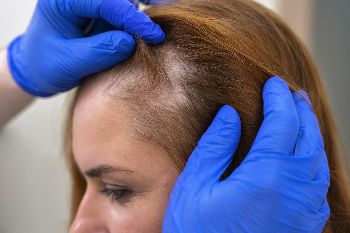 La carbossiterapia contro la caduta dei capelli