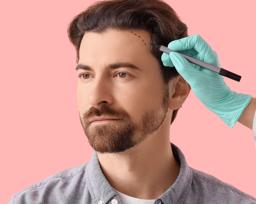 Trapianto di capelli:: cosa sapere prima di decidere